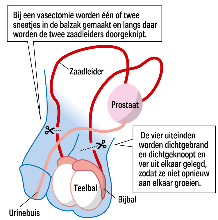 Vasectomie huisarts Amsterdam